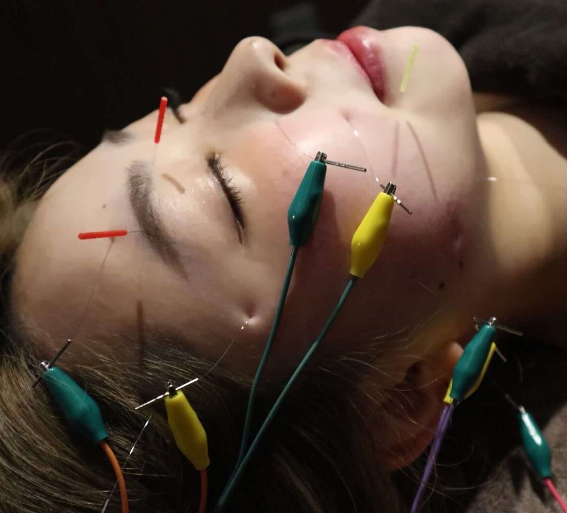 【美容鍼の痛みについて  ハリスパ堀江院】