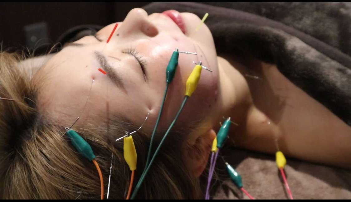 美容鍼を受ける際の注意点とアフターケア