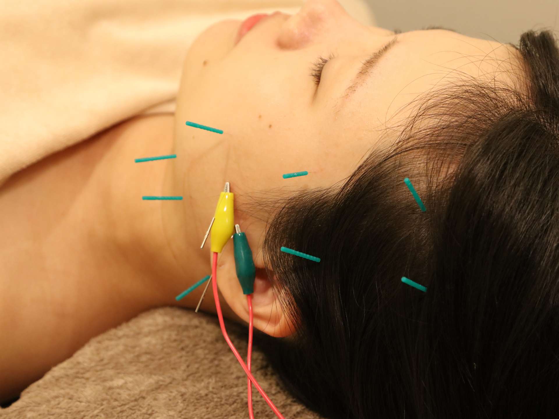 美肌力を促進する美容鍼
